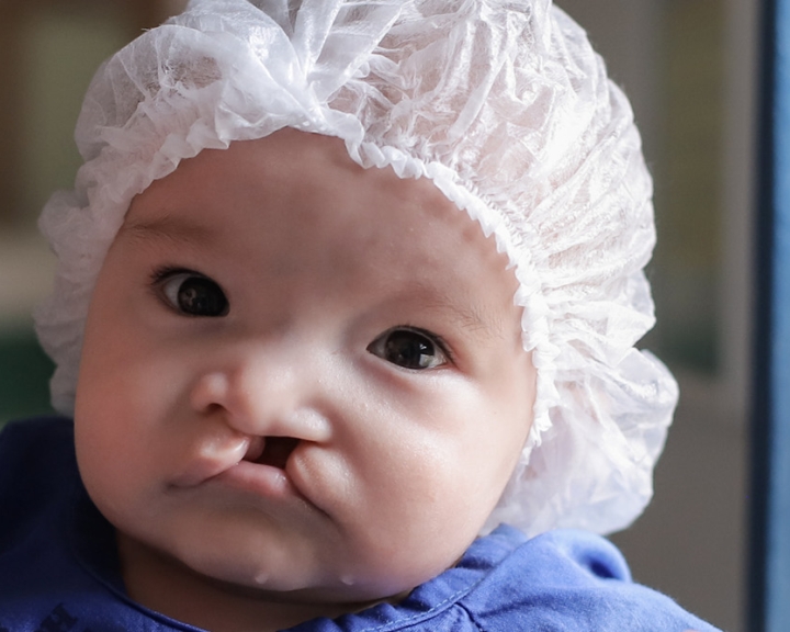 baby in need of cleft surgery