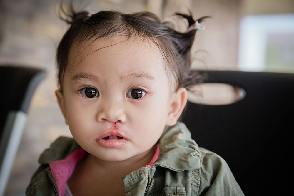 Andrea after her cleft lip surgery