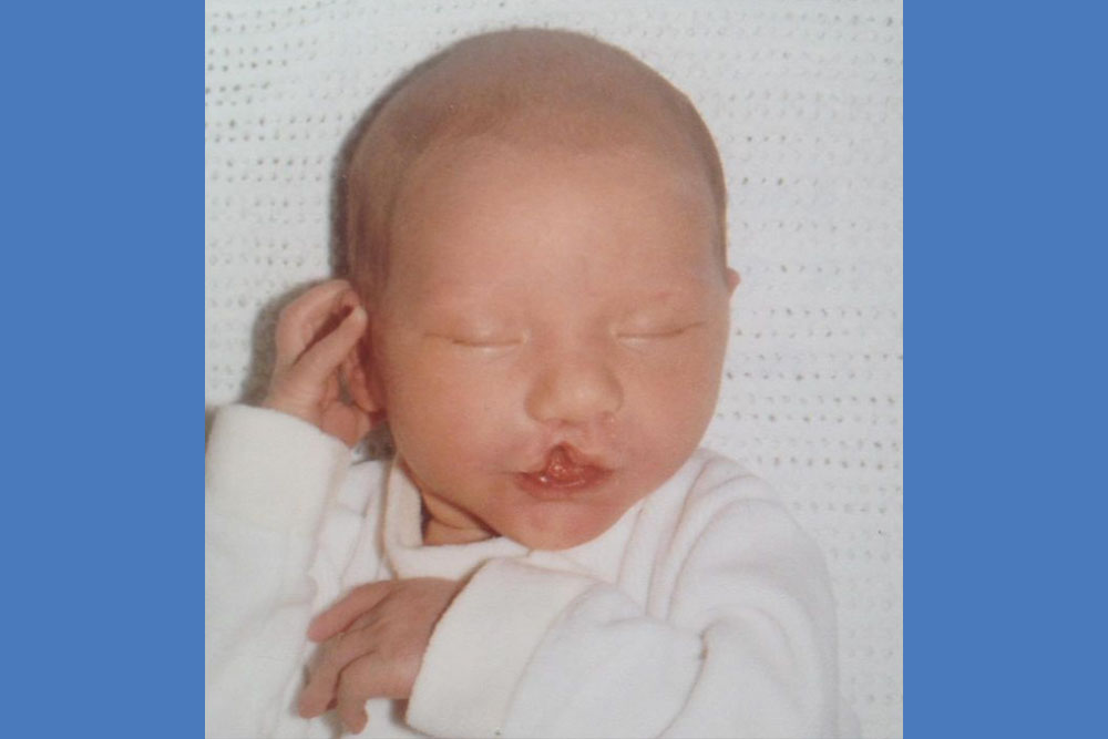 Em as a baby, before cleft surgery