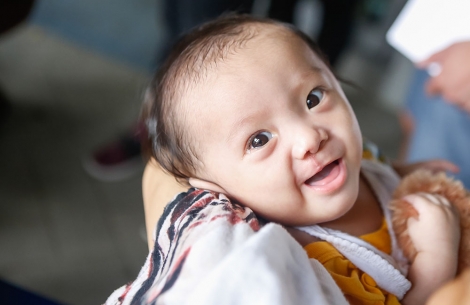 Child smiling to camera after cleft lip surgery