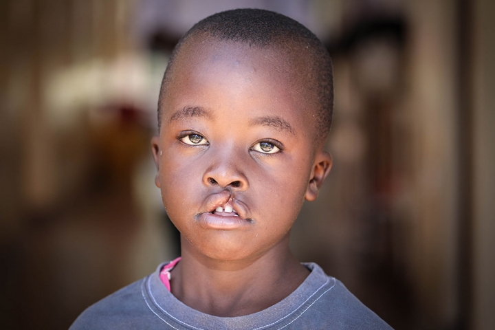 a boy from Kenya with untreated cleft