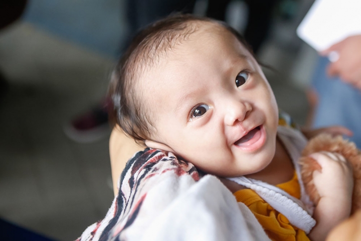 Child smiling to camera after cleft lip surgery