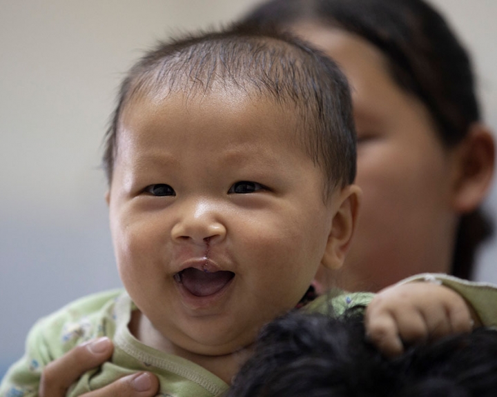 A boy is happy after his cleft surgery