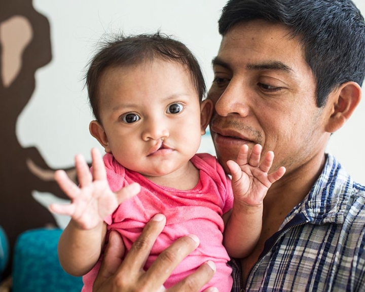 father holding his daughter with a cleft lip