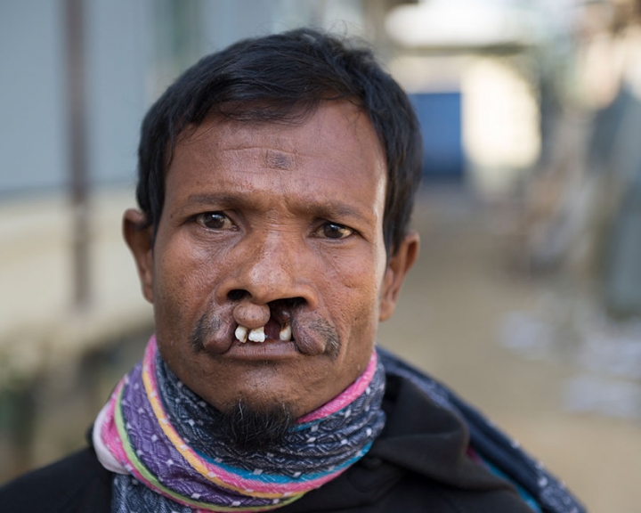 man with a cleft lip in Bangladesh