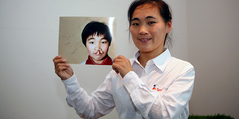 Wang Li - Before and After (Adult)