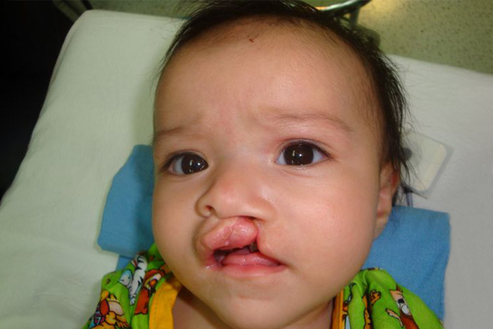 Alexa before cleft surgery