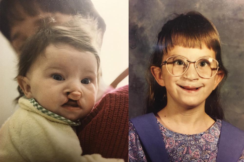Ashley Barbour before cleft surgery and as a child