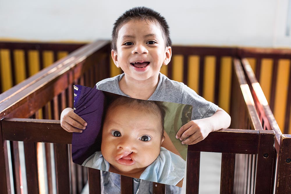 Auner holds an image of himself before cleft surgery