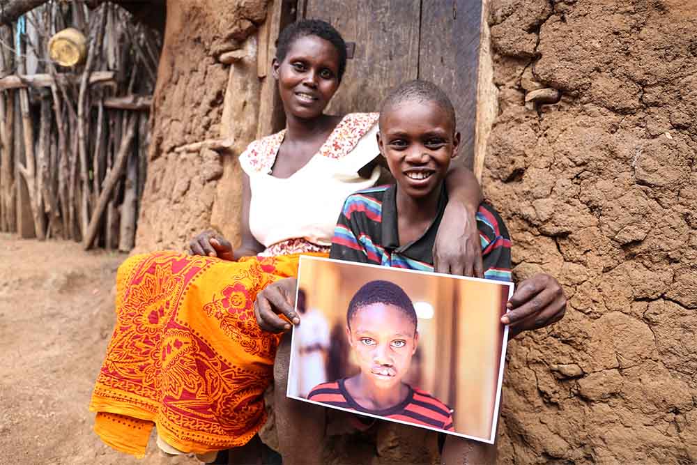 Ayubu poses next to his mother and holds his before cleft surgery image