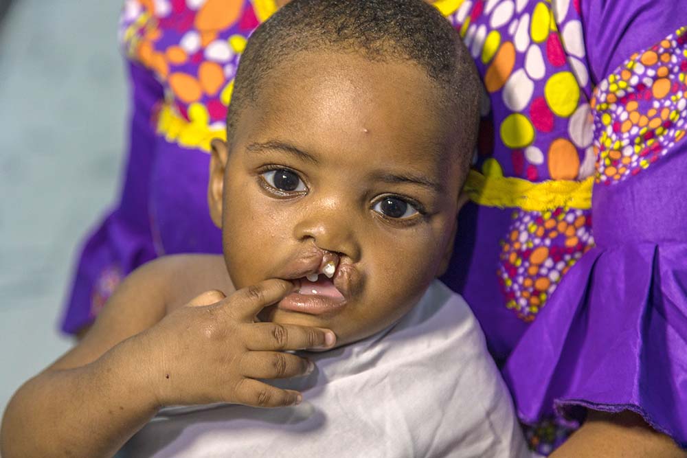 A child waits for surgery during Nigeria Cleft Week