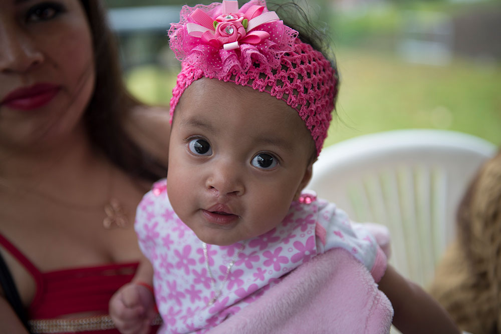 A Smile Train sponsored cleft patient