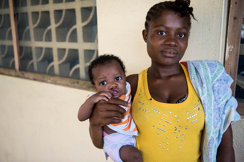 A child waiting for cleft surgery