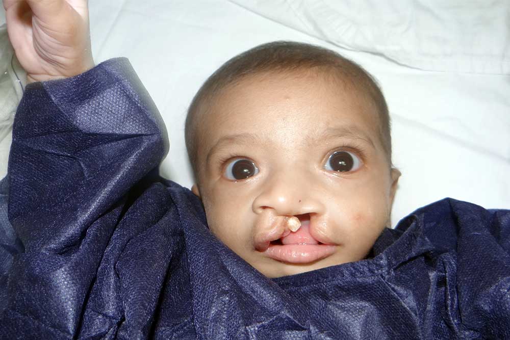 Habeeba before cleft lip surgery