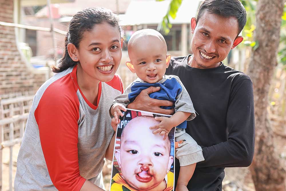 Kenzu's family holds up his before cleft surgery image