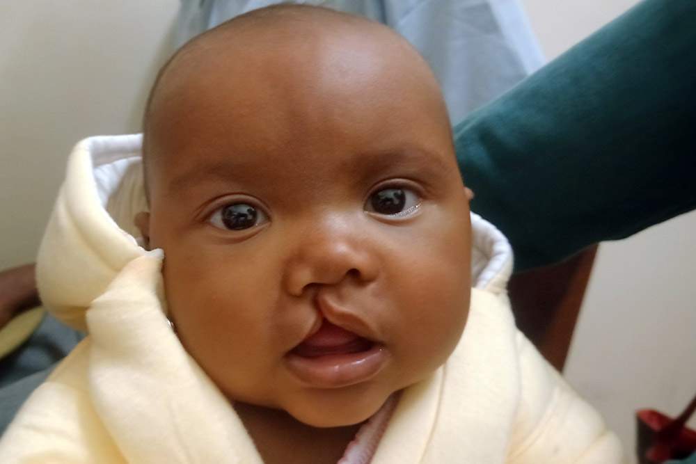A child with an untreated cleft lip from Madagascar