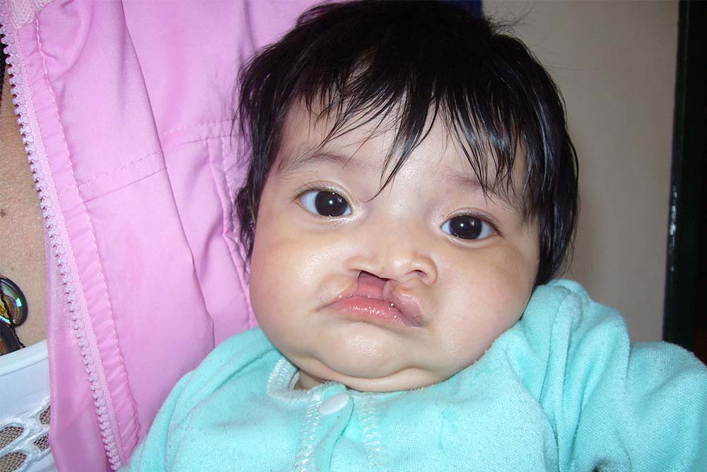 Maria before her cleft surgery