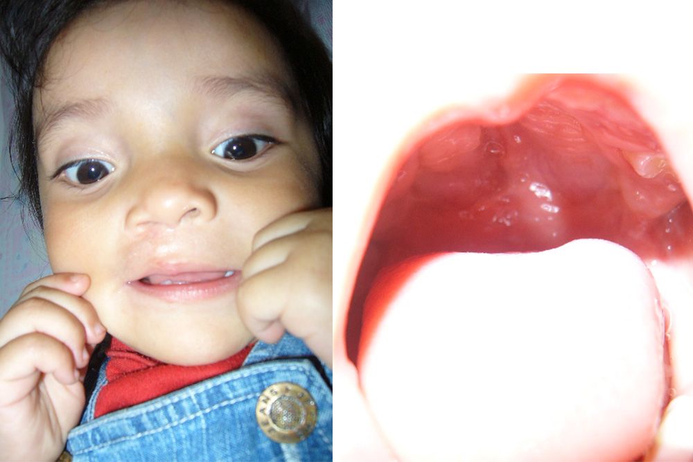 image of Maria's healed cleft palate