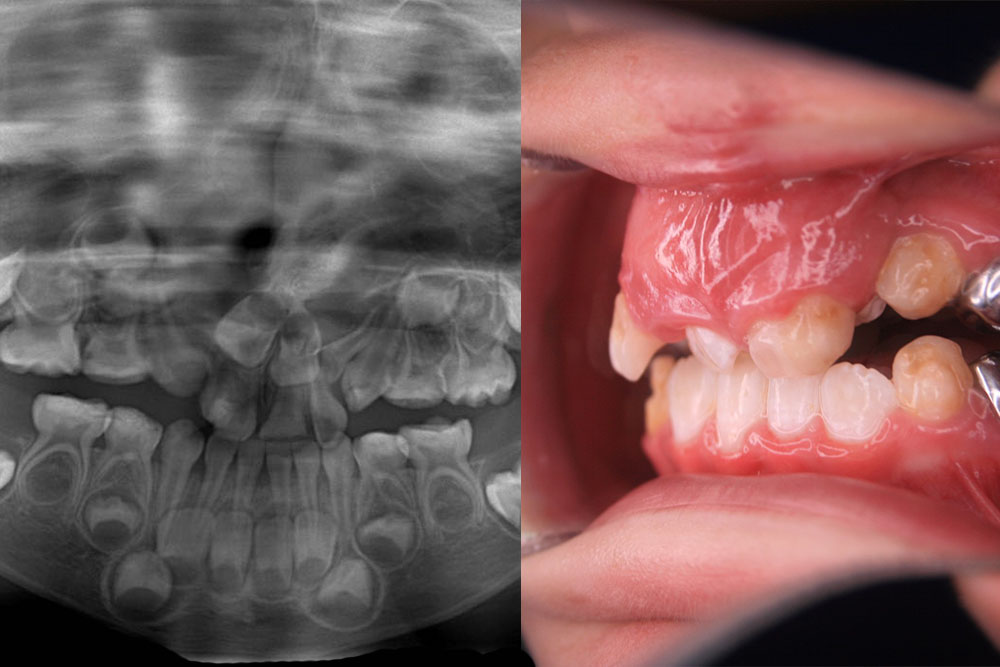 Neitan's teeth and orthodontic images