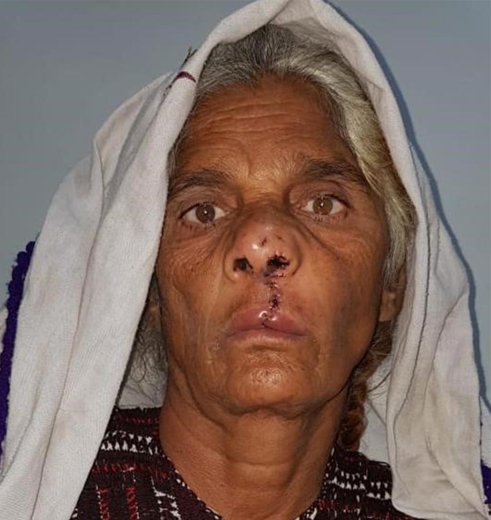 Pyari after cleft surgery