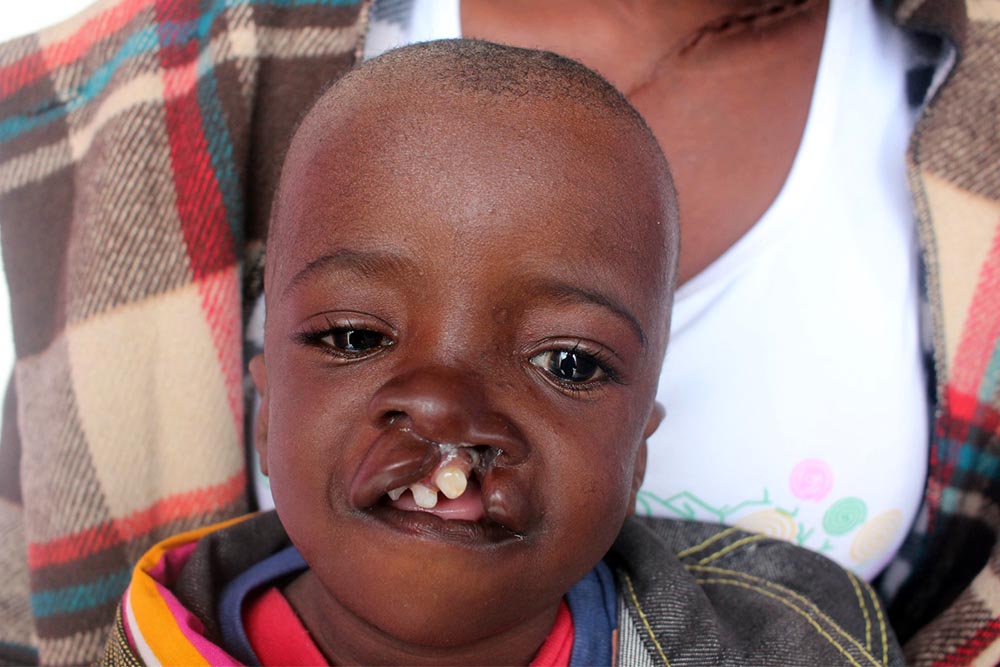 Samson with an untreated cleft lip