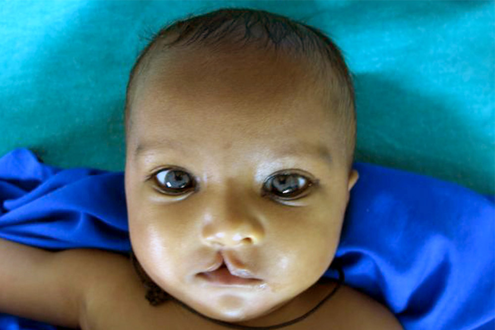 Saraswati as an infant, before cleft lip surgery