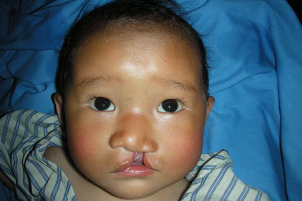Sushila before her cleft lip surgery