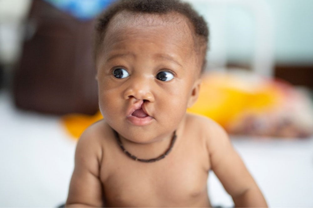 Shukuru awaits his life-changing free cleft surgery in Tanzania