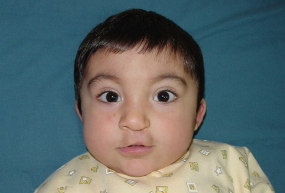 Vicente after cleft plate surgery