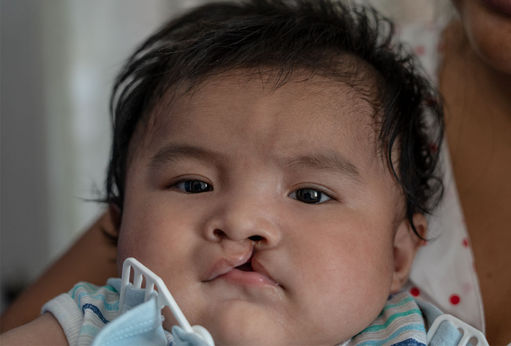 Close-up of Miguel before his free Smile Train-sponsored cleft surgery