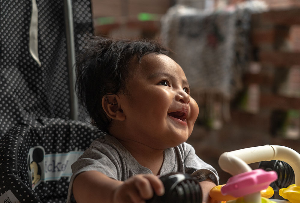 Miguel playing after cleft surgery