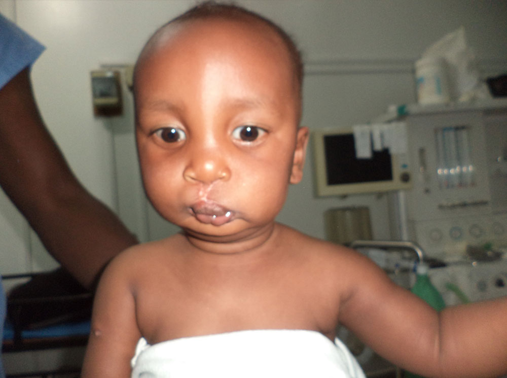 Eric just after cleft palate surgery