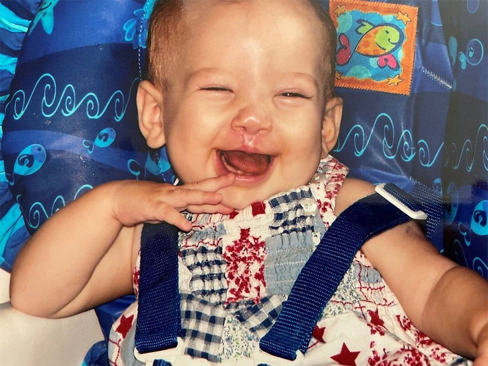 Finley after early cleft surgeries