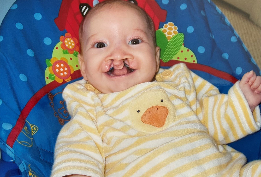 Finley as a baby, before cleft treatment