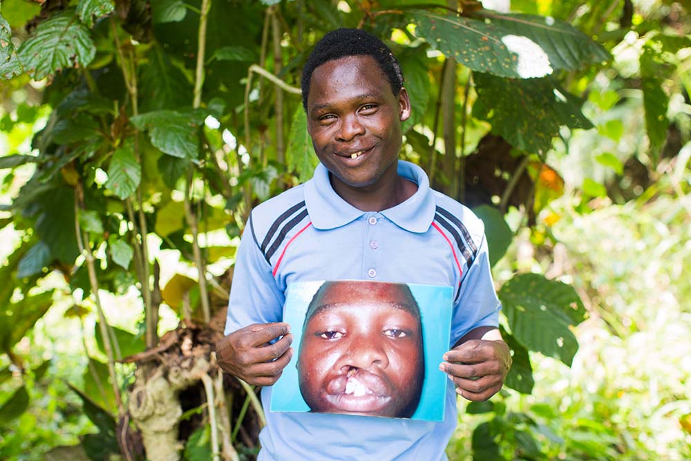 Yusufa holds image of himself before cleft surgery