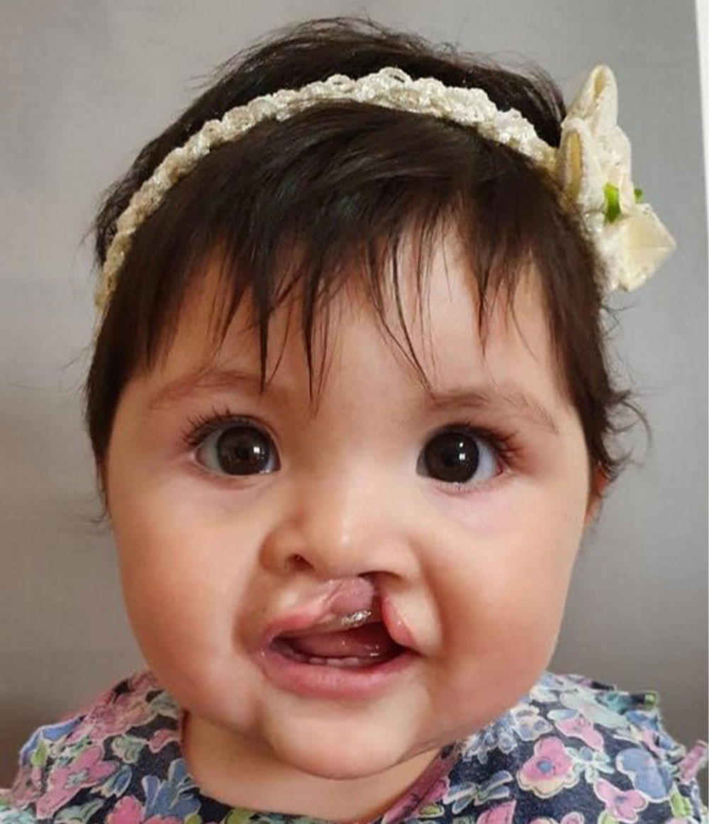 Luaxana before her cleft surgery
