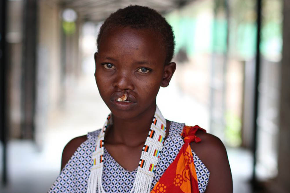 Ndindai needs cleft lip surgery