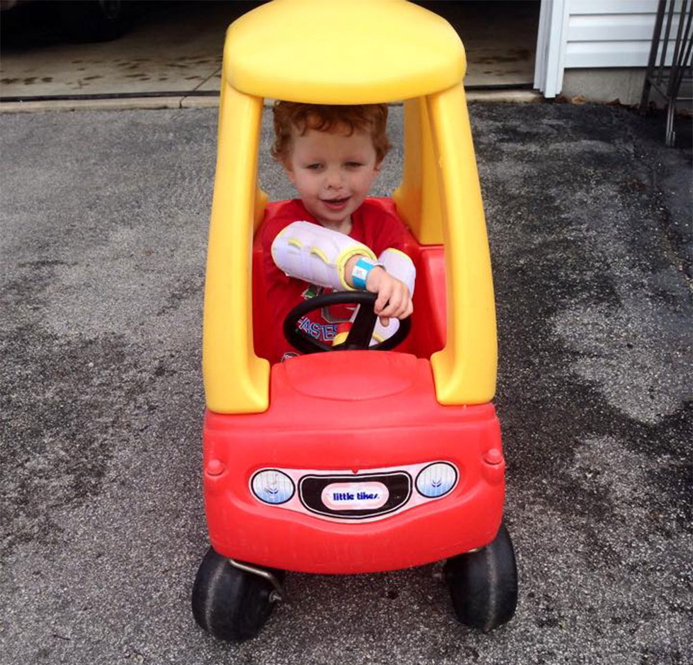 Henry driving a Little Tikes Cozy Coupe after cleft surgery with his arm stabilizers 