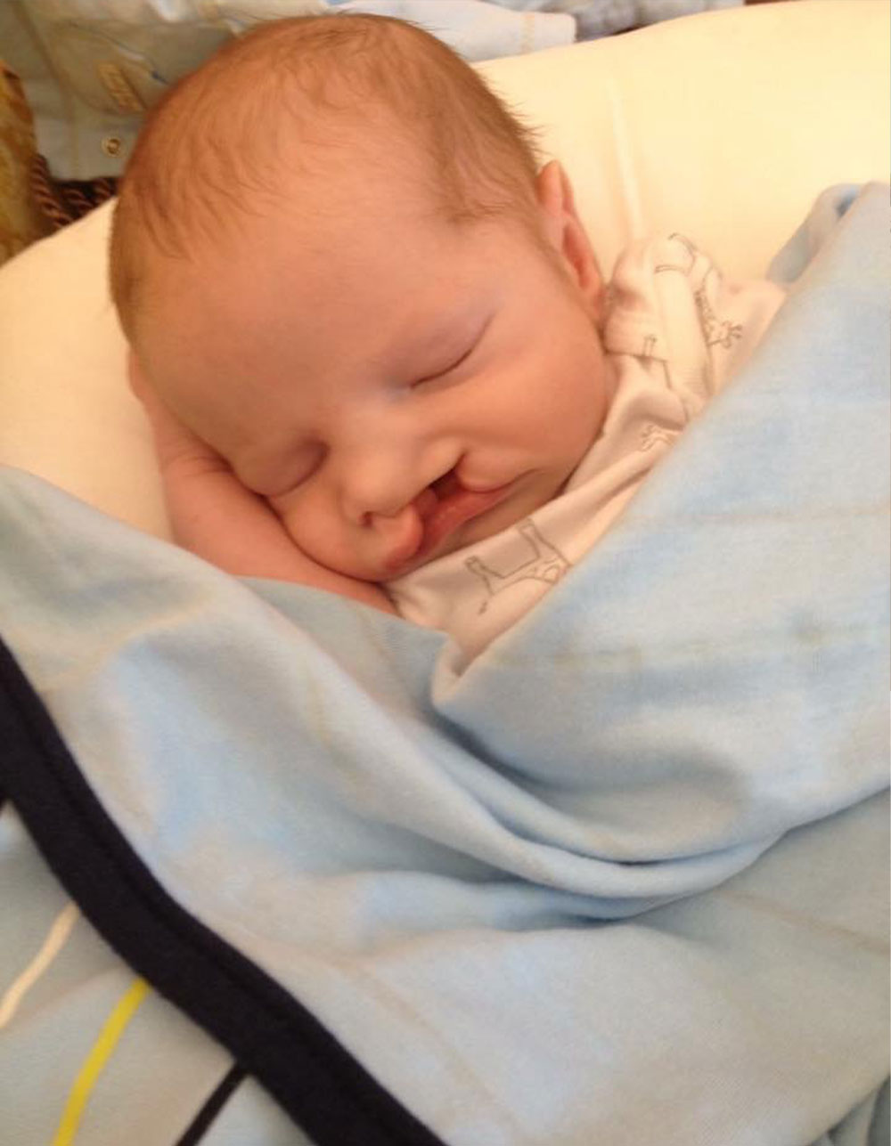 Henry as a newborn, before cleft treatment