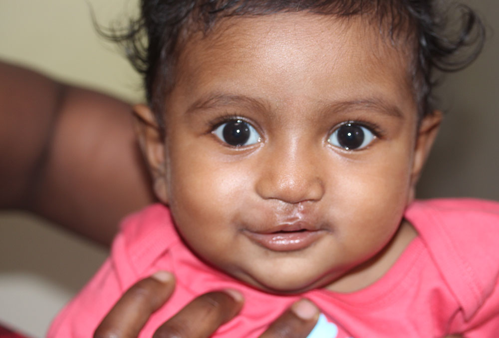 Jaya a few days after cleft surgery