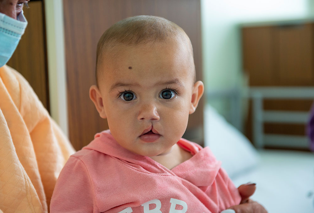 Stefania before cleft surgery