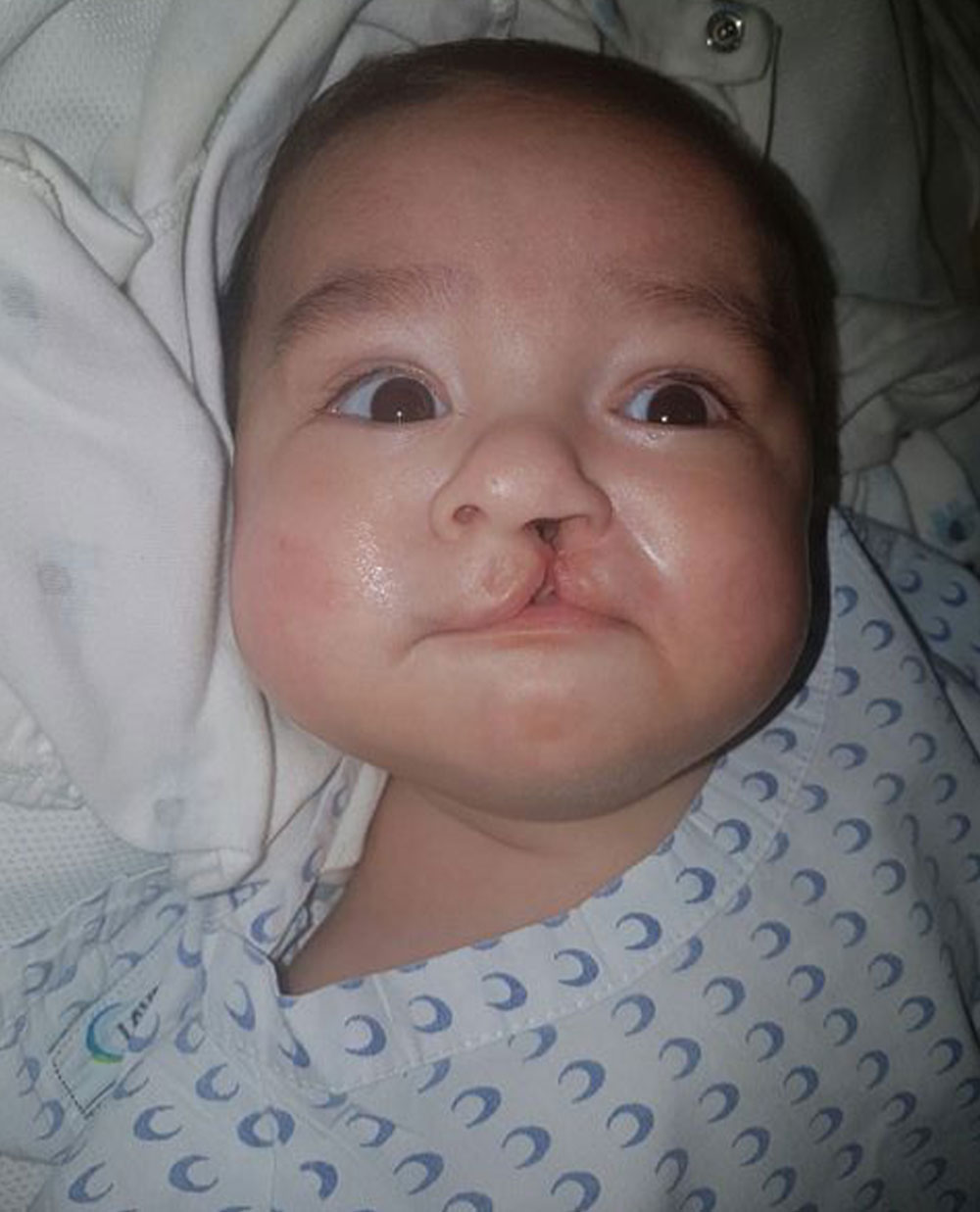 Damian as a baby, before cleft surgery