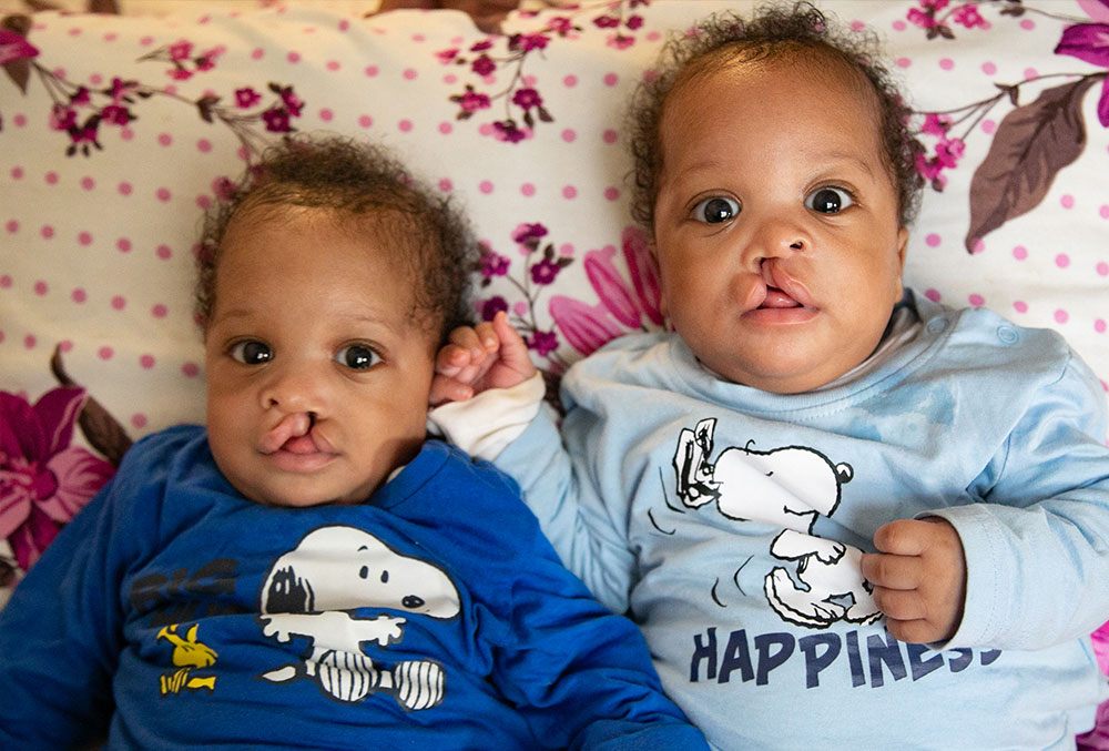 Lloyd and Floyd before their cleft surgeries