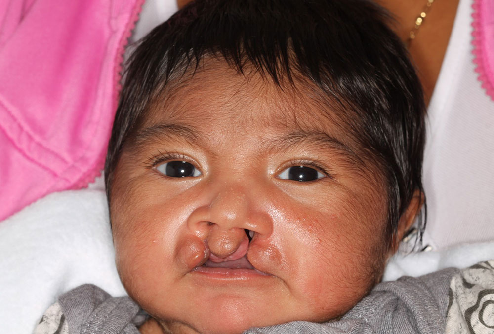 Mathias as a baby before cleft surgery