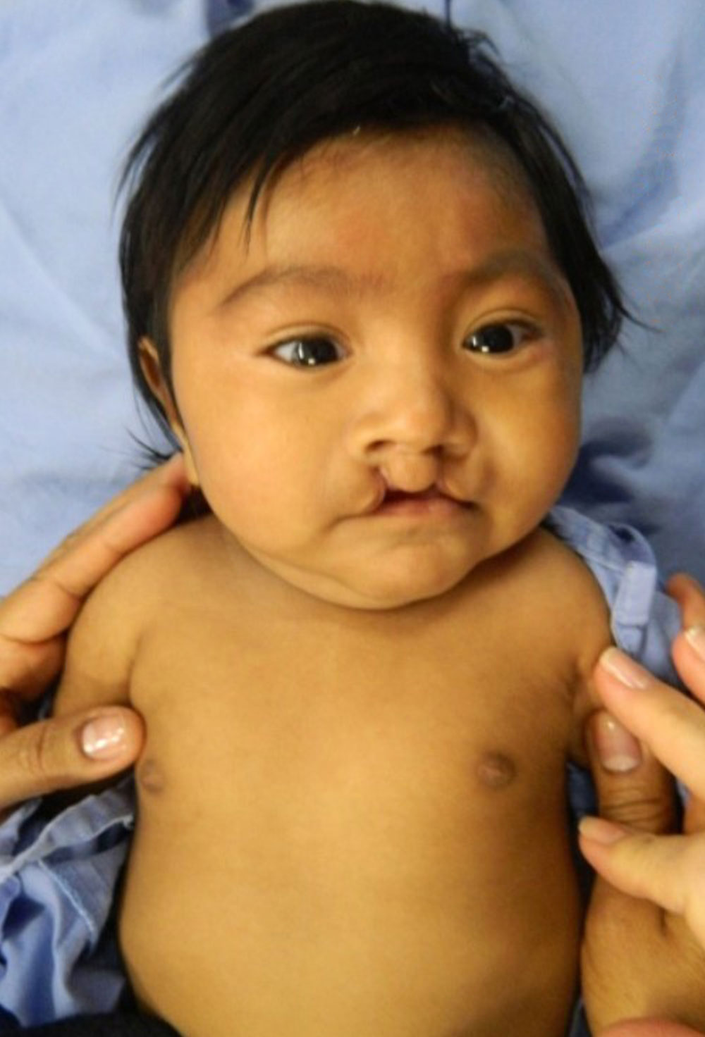 Mathias as a baby before cleft surgery