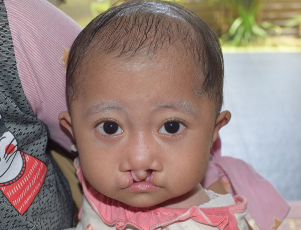Adiba before cleft surgery