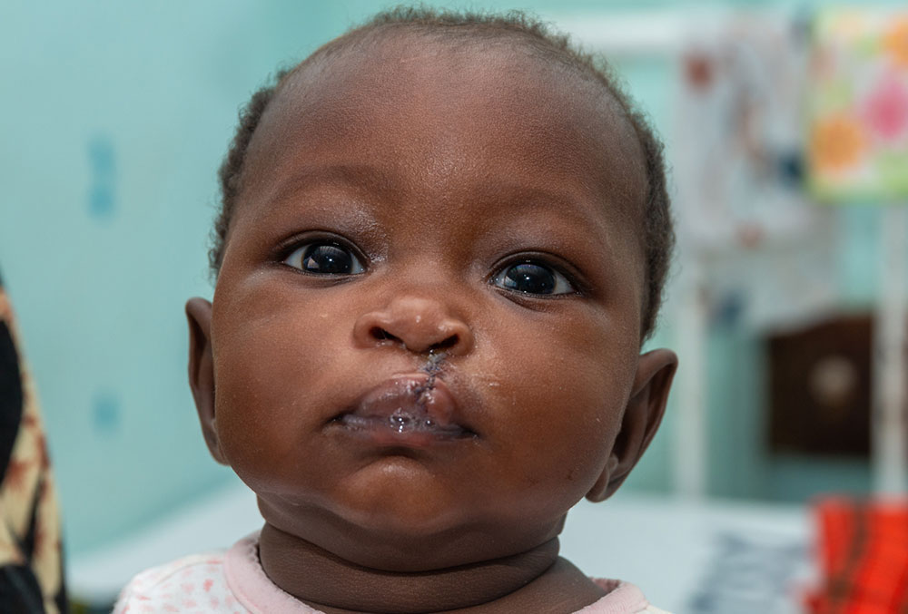 Maleciana right after cleft surgery 