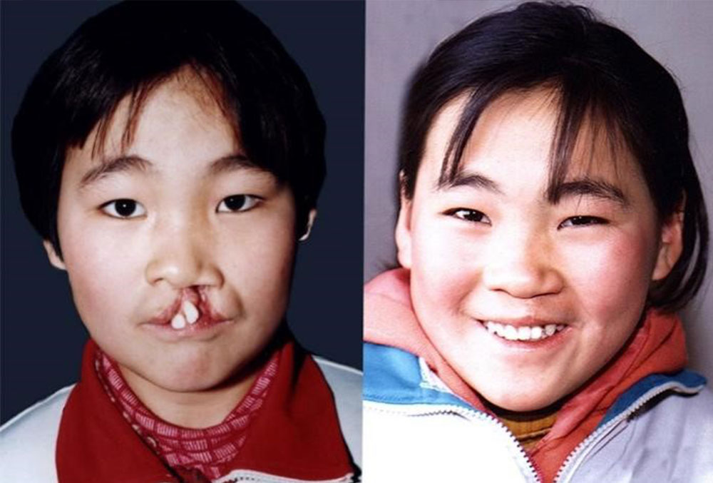 Wang Li before and after cleft surgery