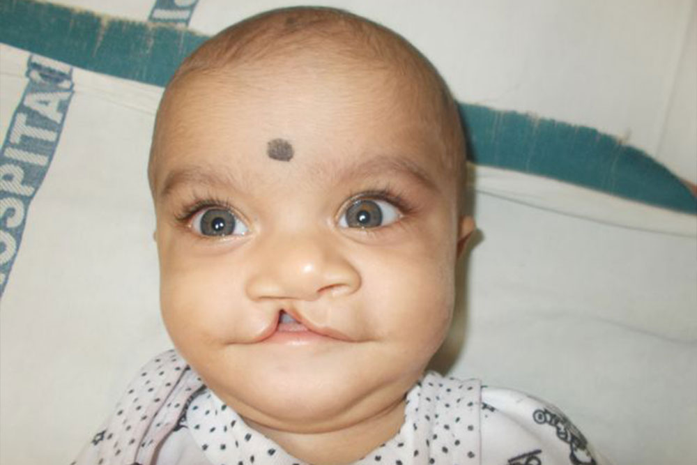 Samrat as a baby, before cleft surgery
