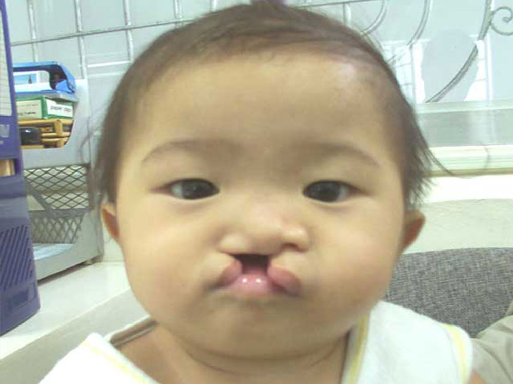 Jian as a baby, just before cleft surgery